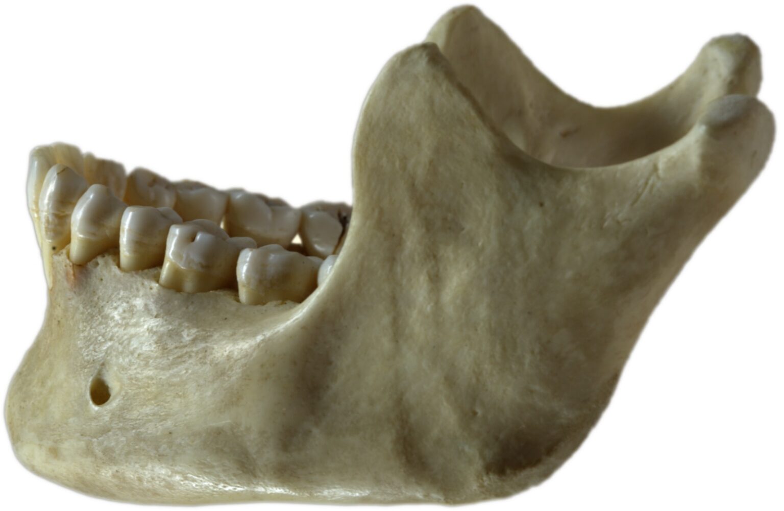 wetaskiwin family dental on jaw bone deterioration
