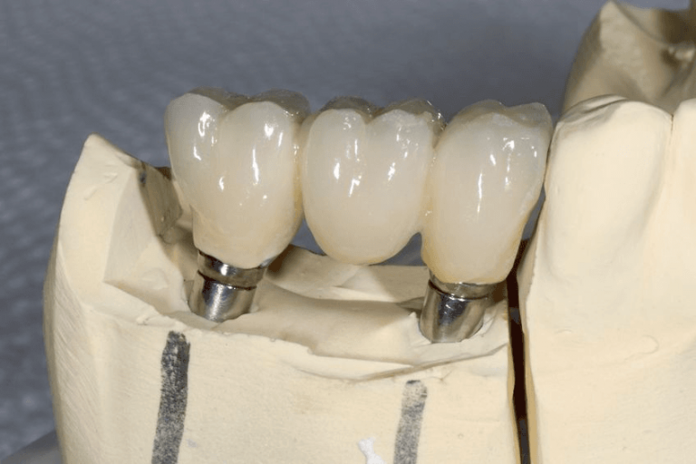 behind the scenes dental crown fabrication