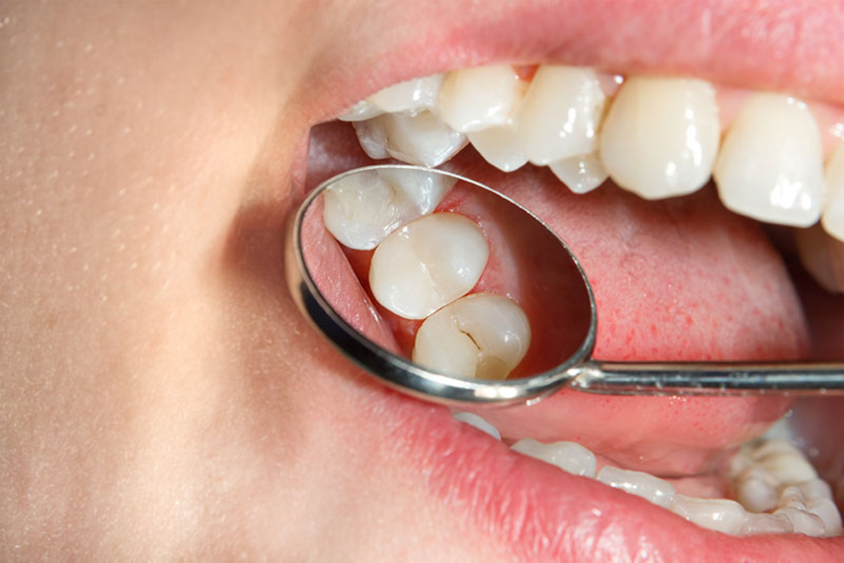 dental sealants q a
