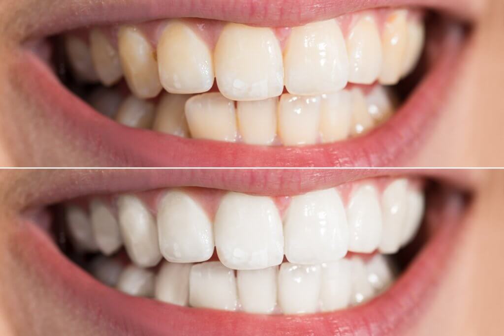 which tooth whitener works best