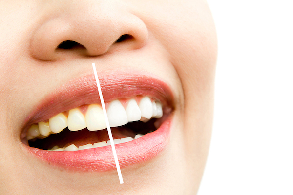 teeth whitening options in wetaskiwin