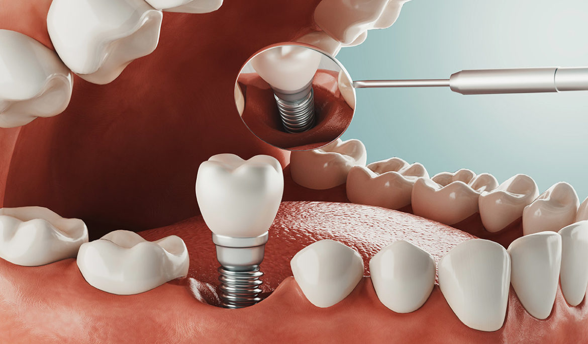 getting ready for a dental implant
