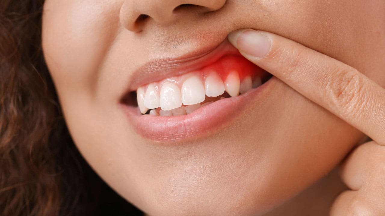 preventing gum disease at wetaskiwin family dental