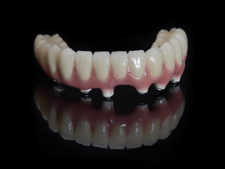 how do implant dentures work