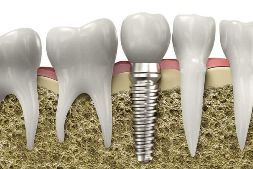 busting myths about dental implants