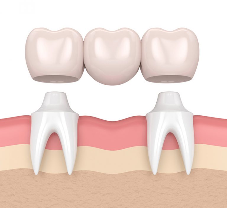 dental bridges in wetaskiwin