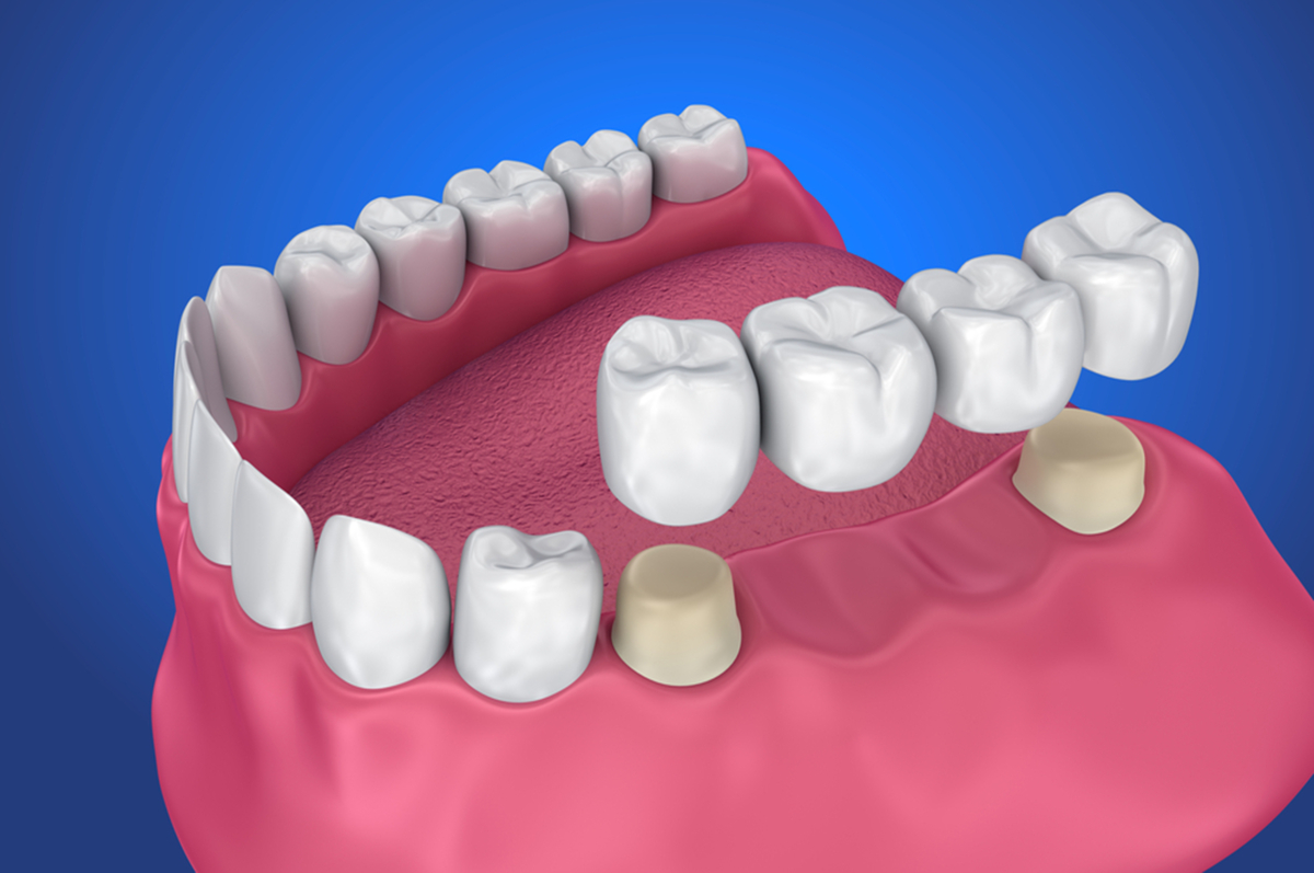 dental bridges vs dental implants