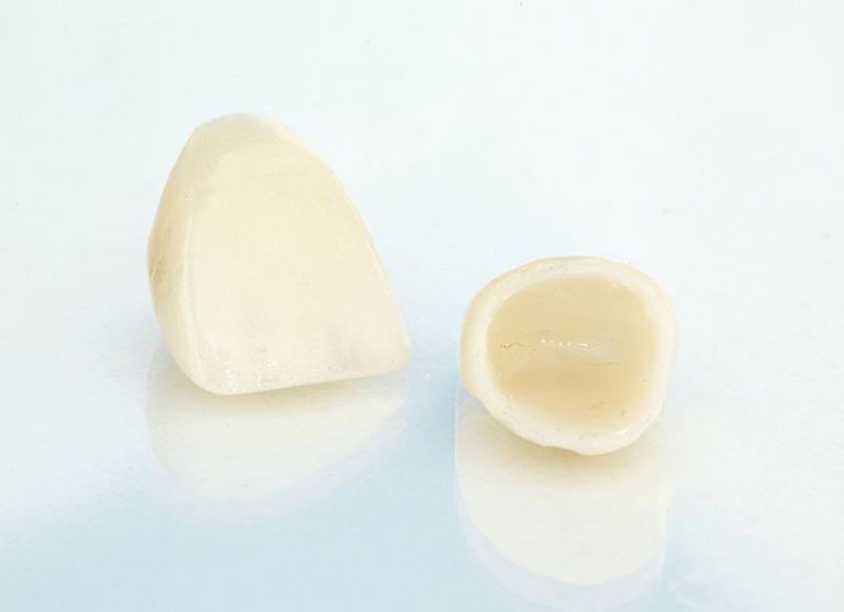dental-crowns in wetaskiwin