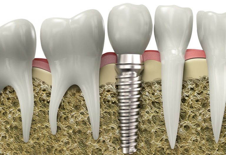 dental-implant in wetaskiwin