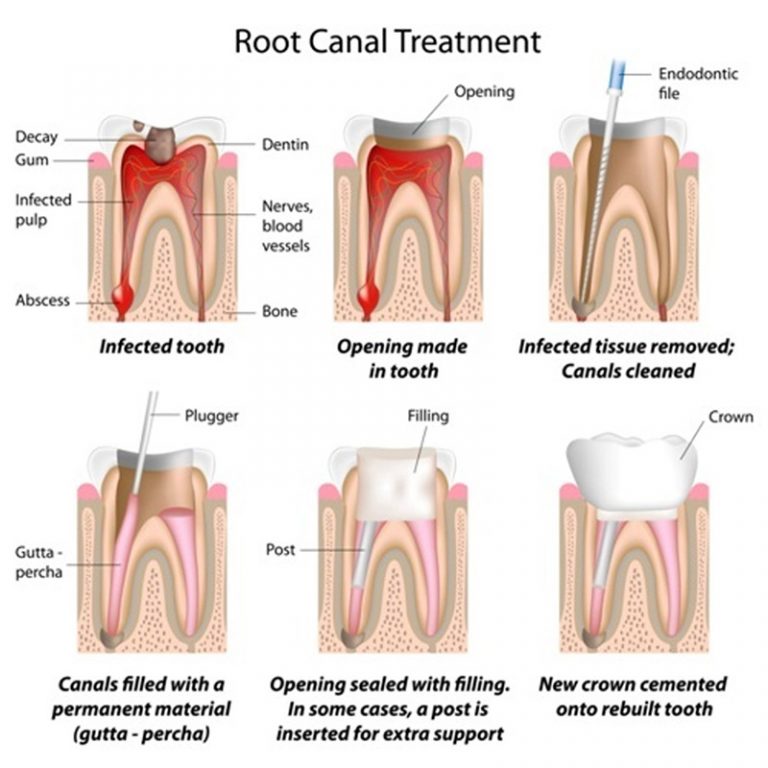root canal therapy in wetaskiwn
