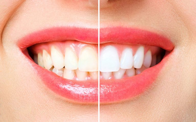 teeth whitening in wetaskiwin