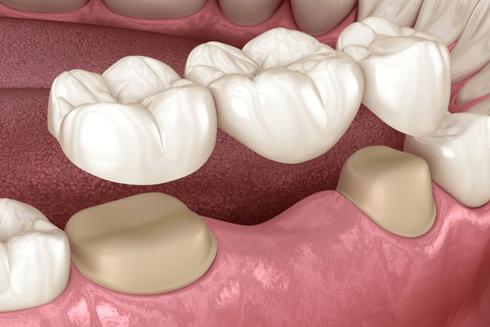 dental bridges types advantages disadvantages