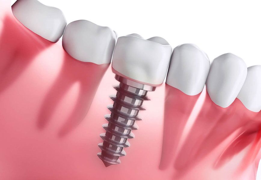 dental implants near you