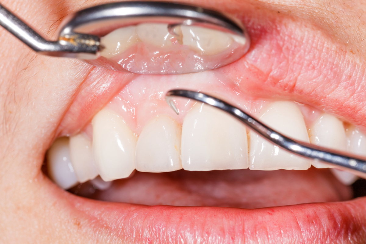 treat your gum disease before its too late