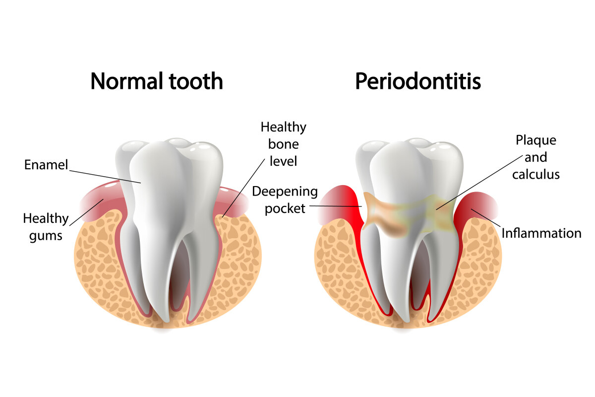 gum disease and your smile restoring oral health with professional care