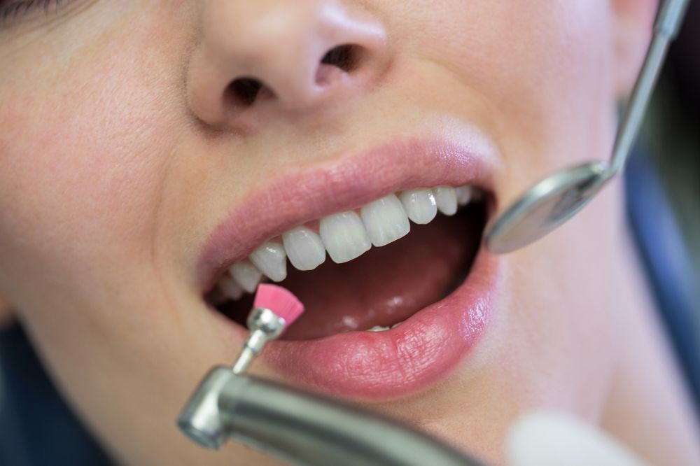 Prep Your Mouth For Veneers Simple Steps For Top Results