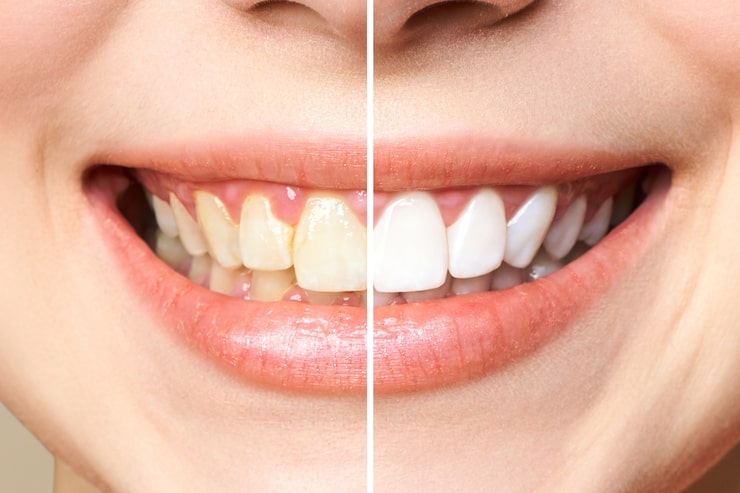 In office vs at home teeth whitening which is right for you